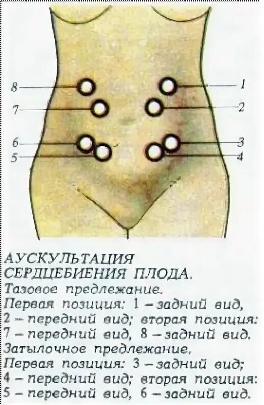 Сердцебиение плода при позиции выслушивается. Выслушивание сердцебиения плода при головном предлежании. 8 точек выслушивания сердцебиения плода. точки выслушивания сердцебиения плода и высоту дна матки. точки аускультации сердцебиения плода.