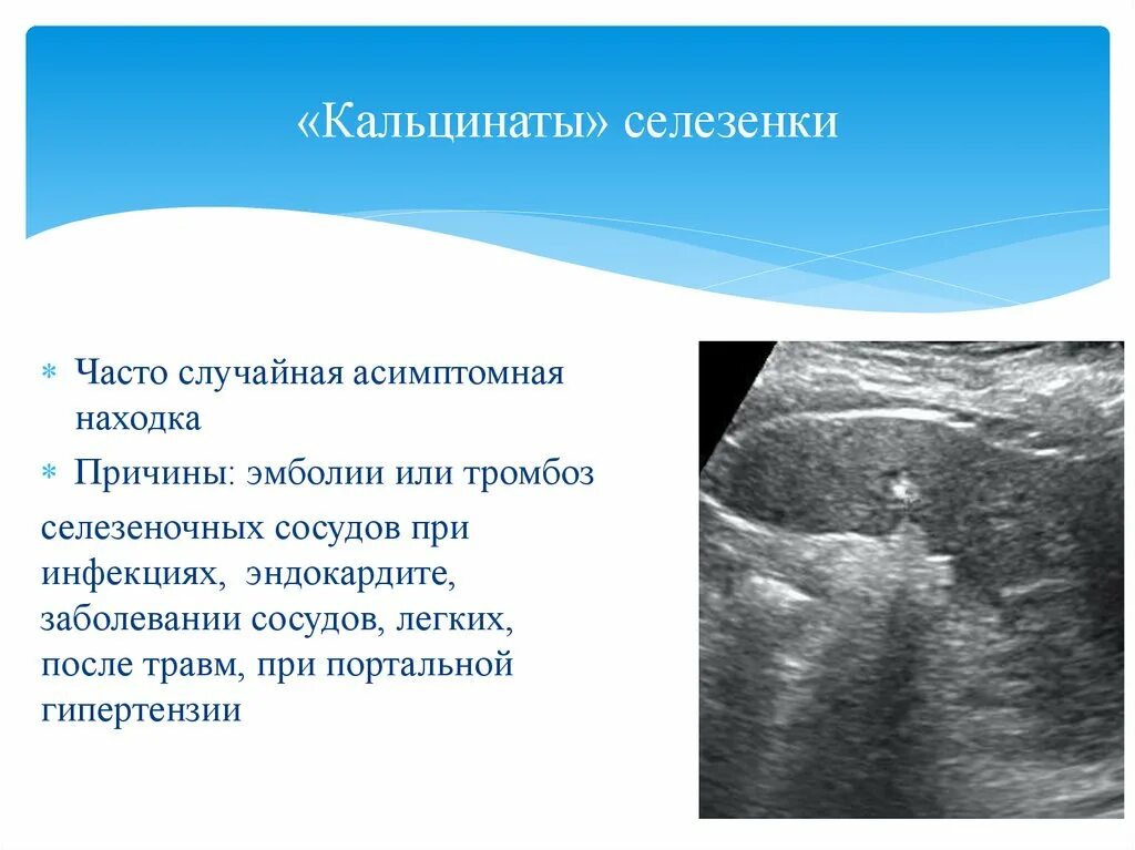 Кальцинат в правой доле. Кальцинат в селезенке на УЗИ. Кальцинаты в паренхиме селезёнки что это. Кальцинат селезенки причины.