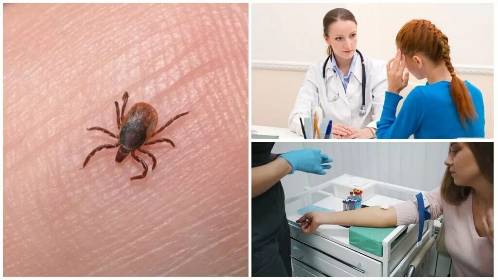 Энцефалит после клеща симптомы. Укус энцефалит клещевой энцефалит. клещевой боррелиоз укус. клещевой эрлихиоз и боррелиоз.