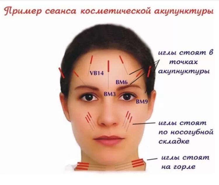 Иглоукалывание омоложение