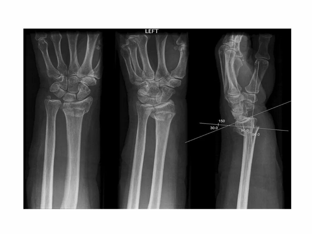 Диагноз перелома лучевой кости. Перелом метаэпифиза лучевой кости. Дистальный метаэпифиз лучевой кости перелом рентген. Дистальный перелом лучевой кости. Внутрисуставной перелом метаэпифиза лучевой кости.