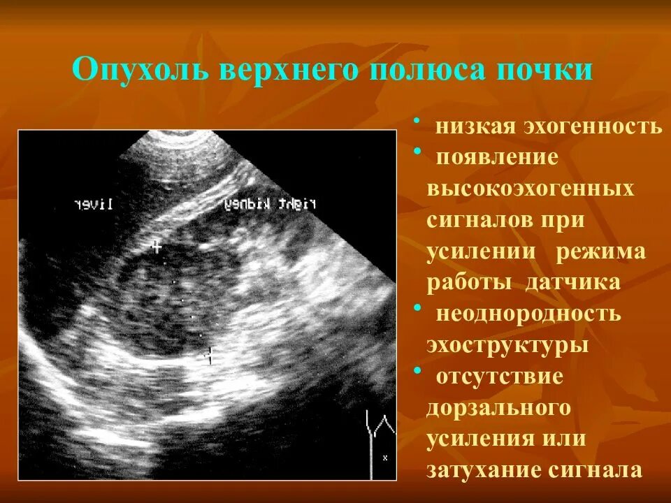 Полюса почки на УЗИ. Верхний и Нижний полюс почки на УЗИ. Эхогенность почек.