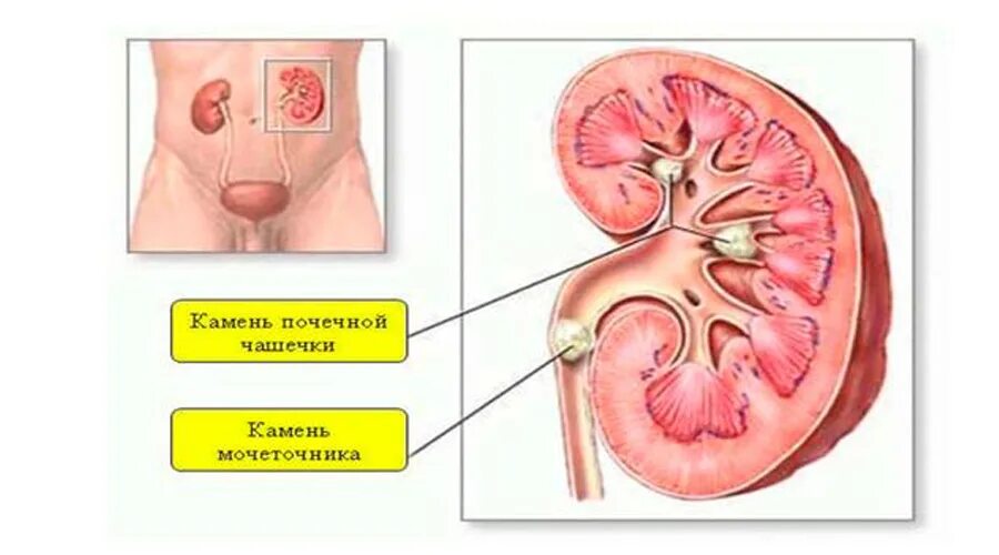 Симптомы поражения почек. Мочекаменная болезнь почек. Симптомы болезни почек. Почки симптомы болезни у женщин.