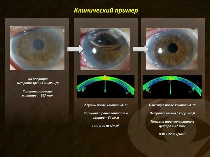 Когда после замены хрусталика восстанавливается зрение глаза. Сквозная кератопластика этапы. Эксцентриситет роговицы ортокератология. Кератопластика этапы операции. Сквозная кератопластика схема.