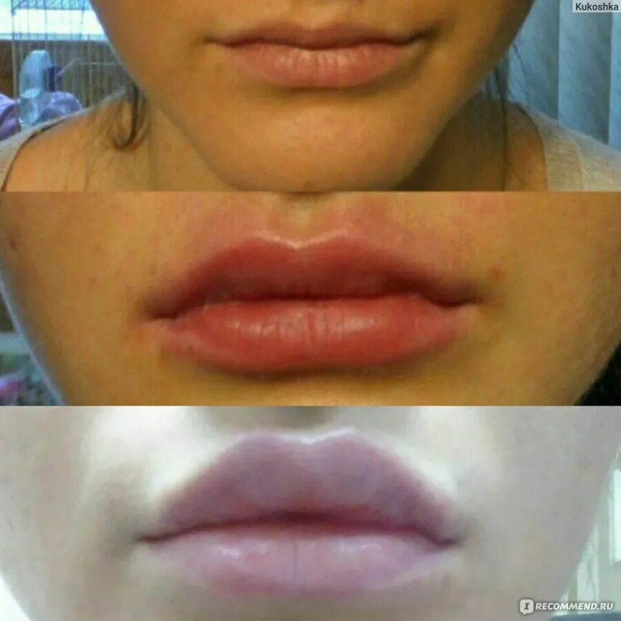 Увеличение губ как заживает. 1 Мл гиалуроновой кислоты в губы после заживления. Зажившие губы 1мл гиалуронка. Губы 1 мл гиалуроновой зажившие.