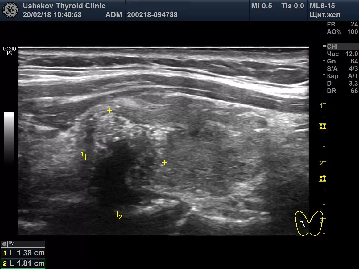 Узел в правой доле щитовидной. УЗИ щитовидной железы микрокальцинаты. Тирадс 5 щитовидной железы УЗИ. Tirads классификация узлов щитовидной железы ультразвуковая. Узел щитовидной железы 5 мм.