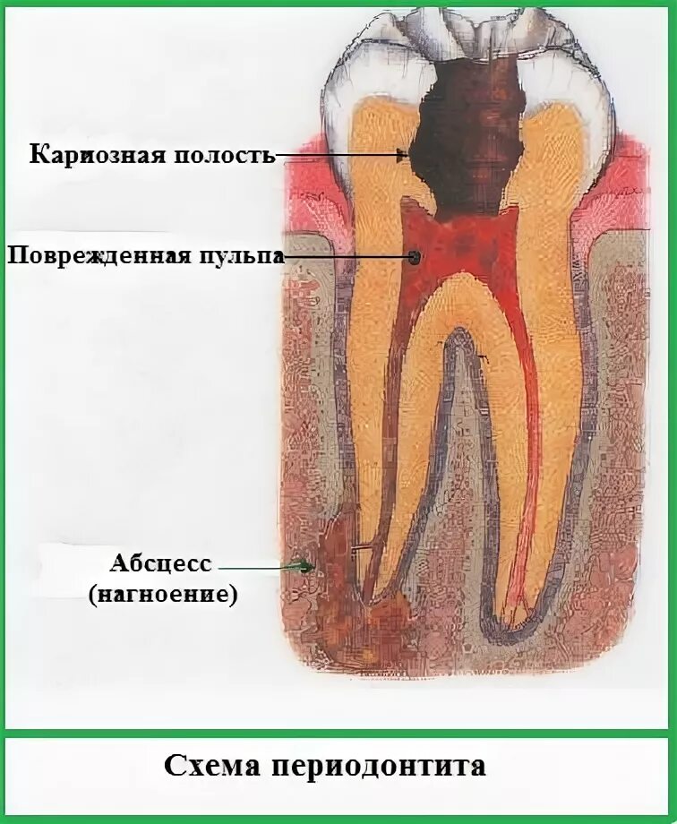 Пульпит кариозная полость. Острый апикальный периодонтит. Апикальный (верхушечный) периодонтит. Строение зуба кариес пульпит. Осложнение лечения периодонтита