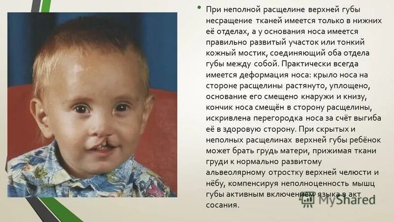 Расщелина Губы И Неба Фото - Mixyfotos.ru