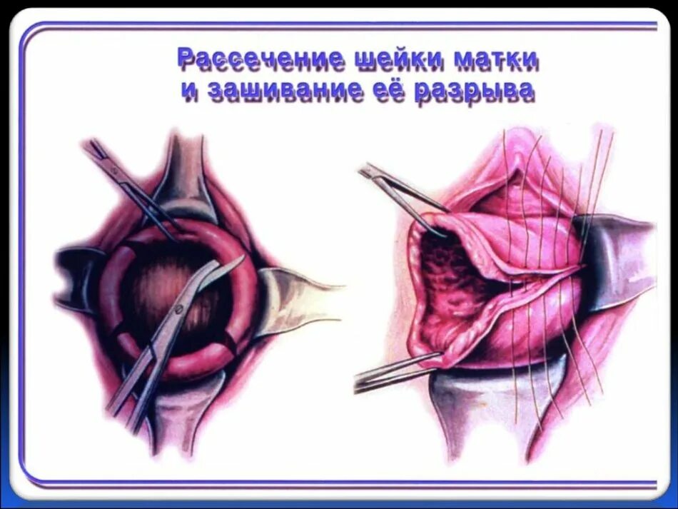 Матка через месяц после родов. Послеродовой разрыв шейки матки. Разрыв после рождения ребенка.