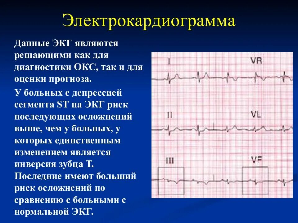 Экг подъем. Окс без подъема St ЭКГ. Окс с подъёмом St ЭКГ признаки. Окс c подъемом сегмента St ЭКГ. ЭКГ С депрессией сегмента St Окс.