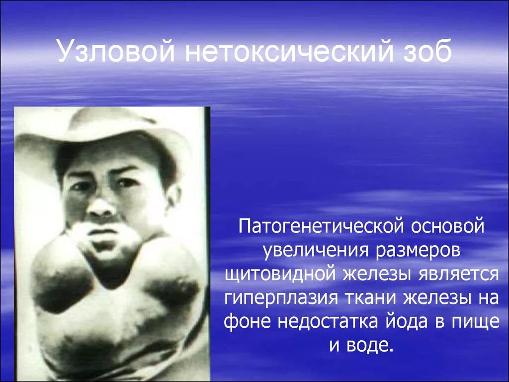 Нетоксический зоб щитовидной. Узловой нетоксический зоб. Нетоксичный одноузловой зоб. Узловой нетоксический зоб щитовидной железы. Нетоксический одноузловой зоб щитовидной железы что это.