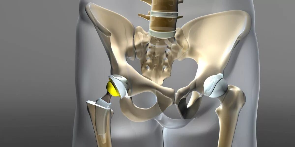 Операция по протезированию тазобедренного сустава. Титановый тазобедренный эндопротез. Implantcast тазобедренный сустав. Эндопротез тазобедренного сустава Германия. Искусственный сустав.