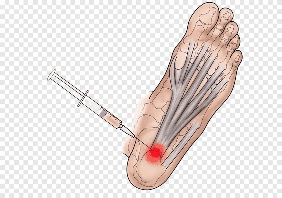 Фасциит стопы. Подошвенная фасция стопы. Плантарный фасциит стопы. Разрыв плантарной фасции стопы. Подошвенный фасциальный фиброматоз.