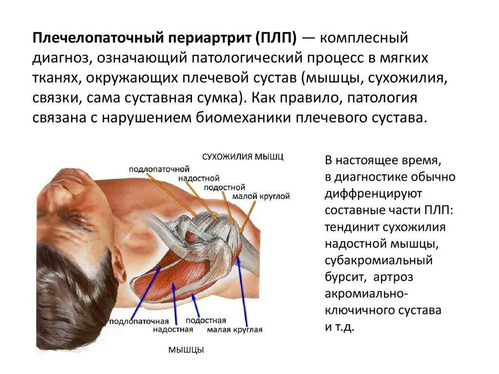 Плечевой периартрит что это