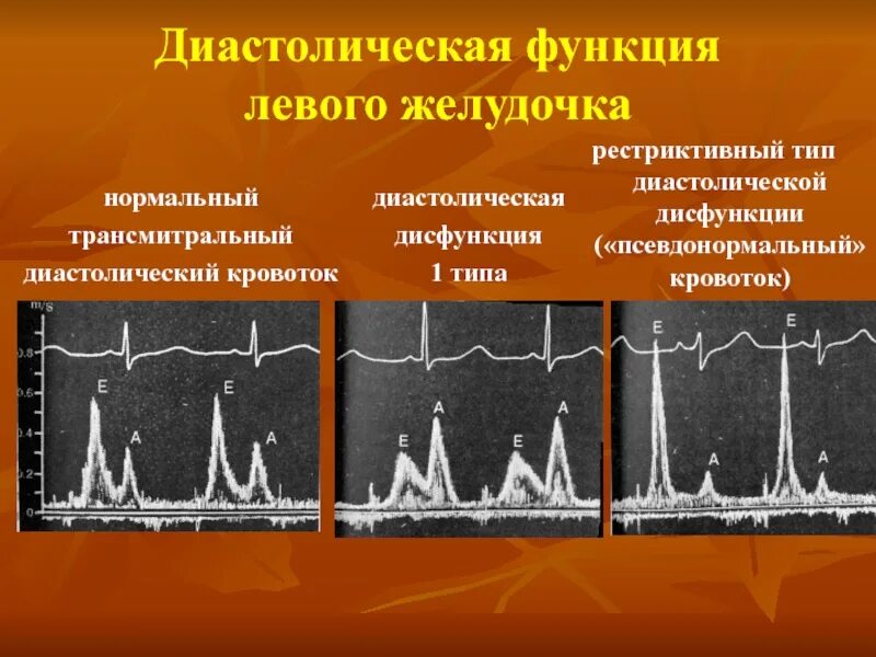 Дисфункции желудочков сердца. Трансмитральный кровоток норма. Диастолическая функция левого желудочка. Трансмитральный кровоток 1 типа. Диастолическая дисфункция лж 2 типа.