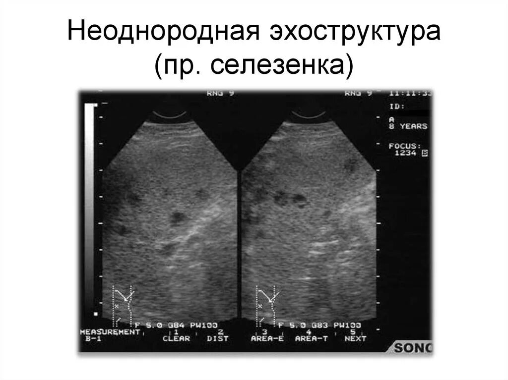 Диффузно однородная. Эхоструктура неоднородная селезенка. Ячеистая структура селезенки. Эхоструктура неоднородная. Эхоструктура селезенки.