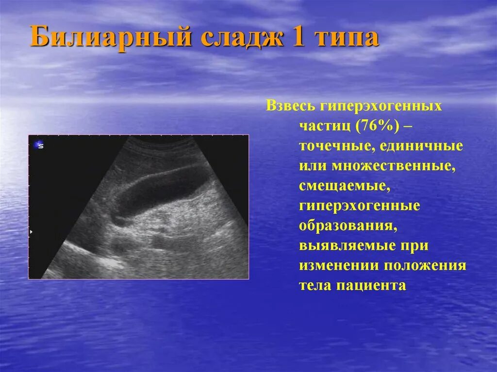 Узи жкб. УЗИ сладж синдром желчный. Билиарный сладж 1 типа. Билиарный сладж в желчном пузыре. Холестероз желчного пузыря на УЗИ.