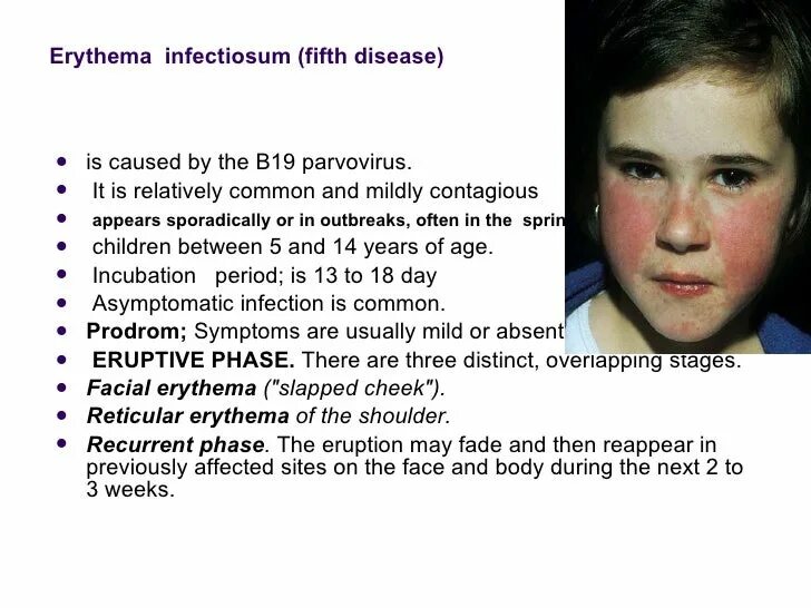 Парвовирус у детей лечение. Инфекционная эритема заразна. Инфекционная эритема симптомы.