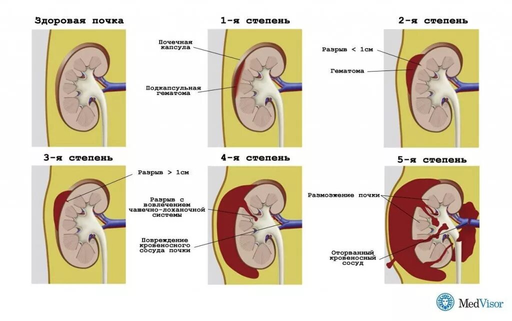 За сколько проходят почки. Подкапсульная гематома почки кт. Хроническая подкапсульная гематома почки на кт. Паранефральная гематома почки. Паранефральная гематома на кт.