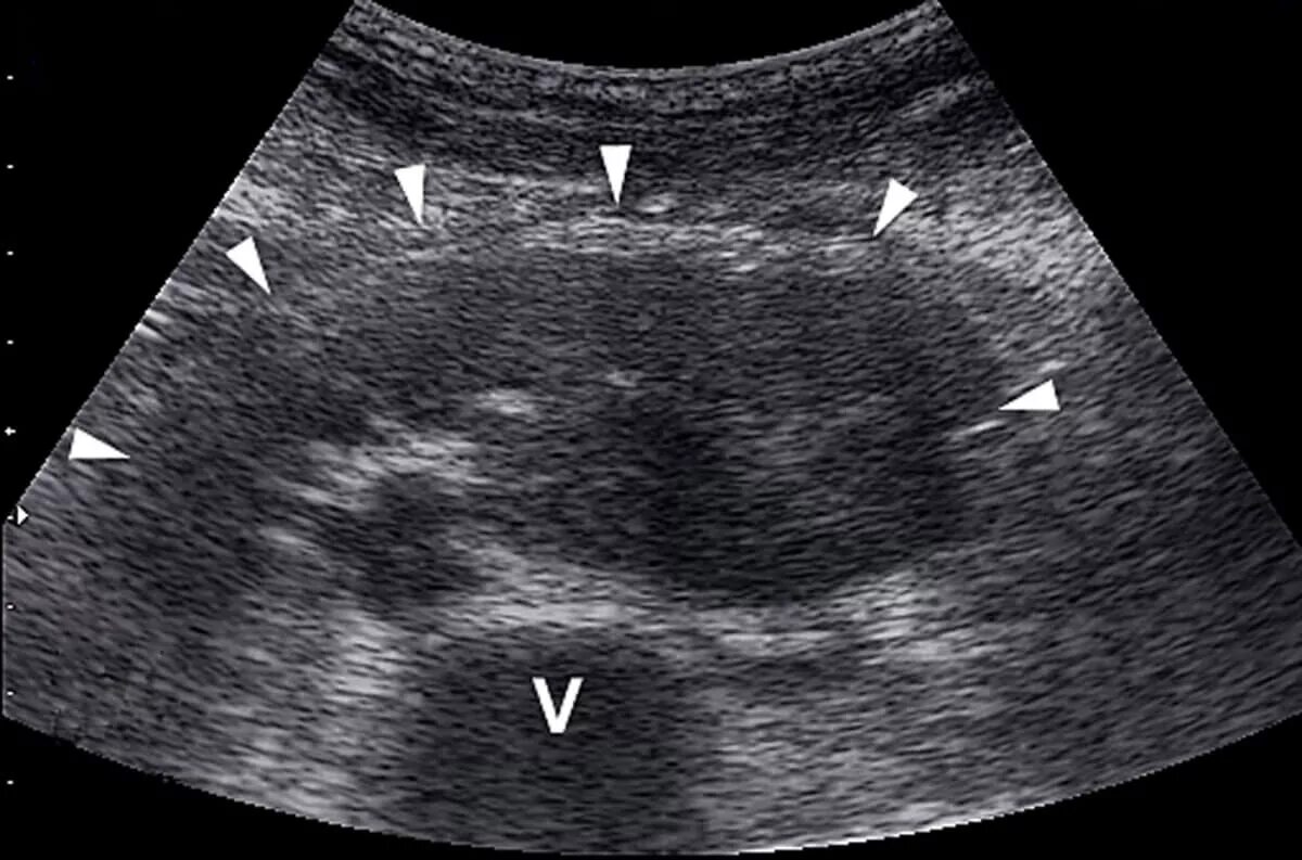 Узи почек диагнозы. Подковообразная почка по УЗИ. УЗИ почек подковообразная почка. Пиелонефрит подковообразной почки. Ультразвуковое исследование почек (УЗИ).