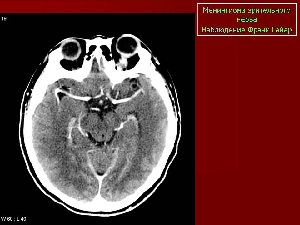 Мрт глазного нерва. Менингиома зрительного нерва кт. Менингиома зрительного нерва мрт. Менингиома головного мозга кт. Менингиома зрительного нерва гистология.