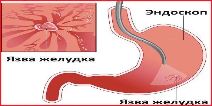 Боль в желудке через час после еды