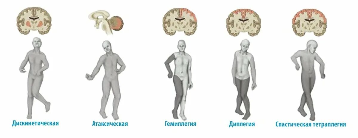 Нижних конечностей и головного мозга. ДЦП формы спастическая гемиплегия. Спастическая диплегия форма ДЦП. Атаксическая форма ДЦП. Церебральный паралич ДЦП.