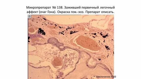 Первичный туберкулезный аффект