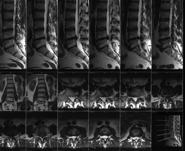 Мрт пояснично-крестцового отдела позвоночника Рязань. Мрт крестцового отдела позвоночника. Мрт позвоночника поясничного. Мрт позвоночника th12-s3 отделы.
