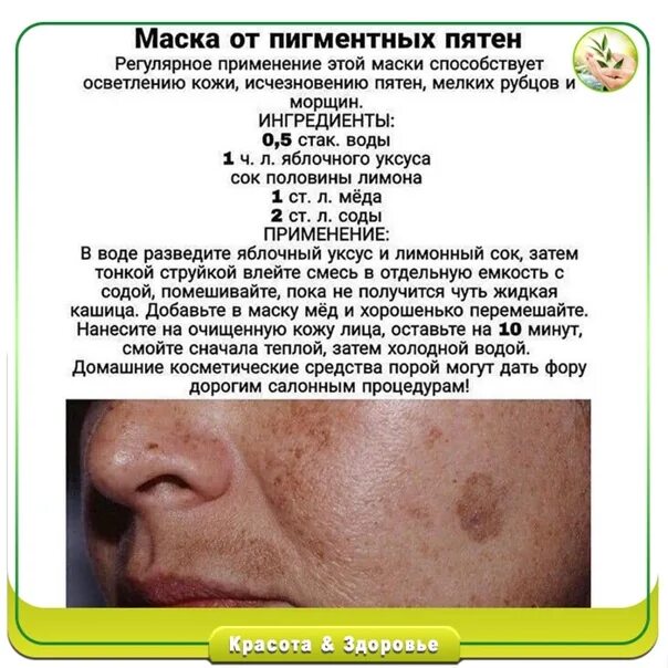 Можно ли избавиться от пигментных пятен. Рецепт от пигментных пятен. средство от пигментных пятен на теле. маска от пигментных пятен. вырезки с рецептами от пигментных пятен.