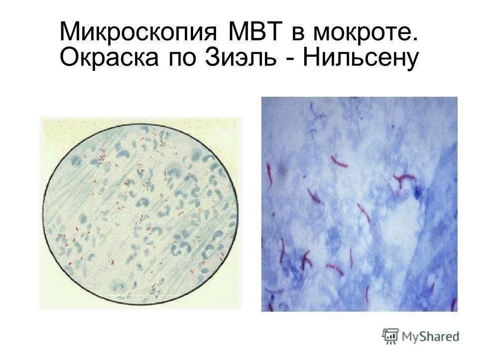 Мокрота окраска. Микроскопия мокроты по Цилю-Нильсену. Микроскопия МБТ по Цилю-Нильсену. Микроскопия мокроты эпителий: единично. Микроскопия мазка мокроты.