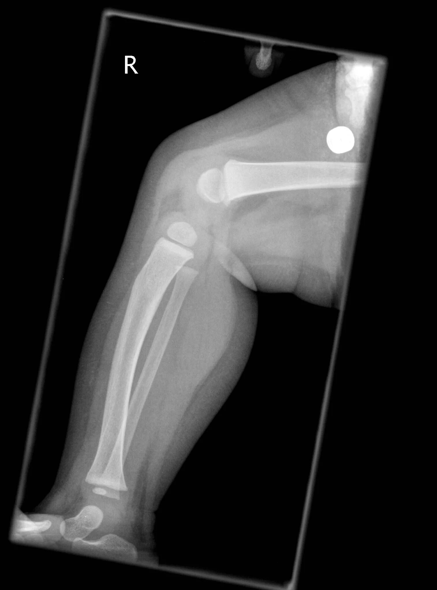 Avascular necrosis of the femoral head vs norma. Journal x ray. Xray снимок. Journal x ray. рентген x ray слово.