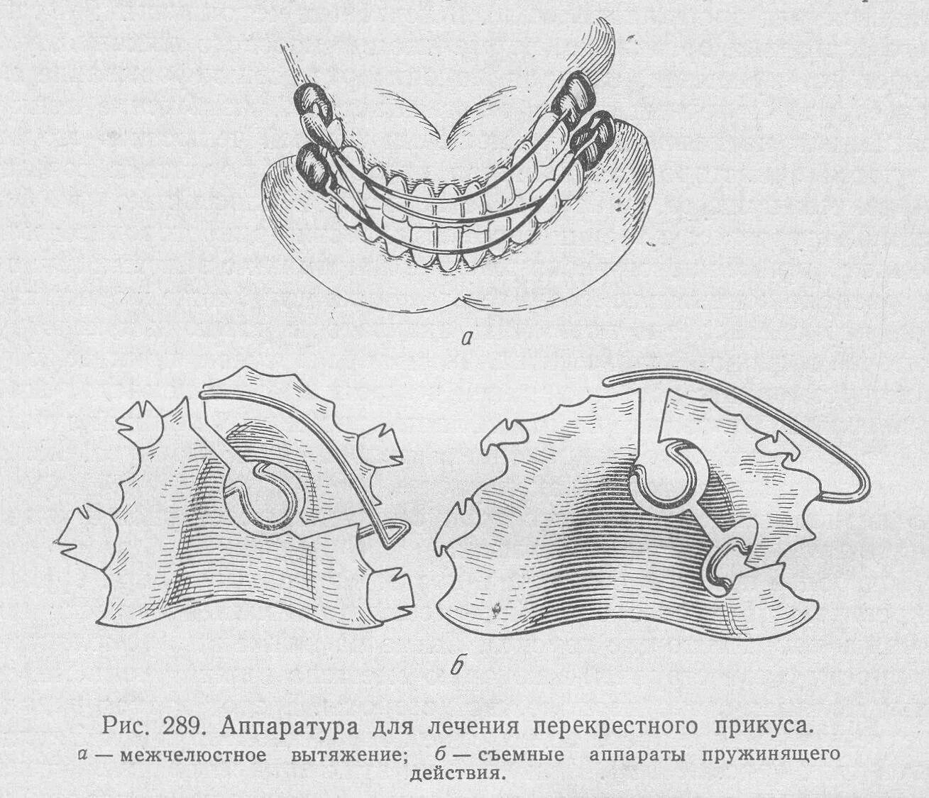Перекрестные зубы