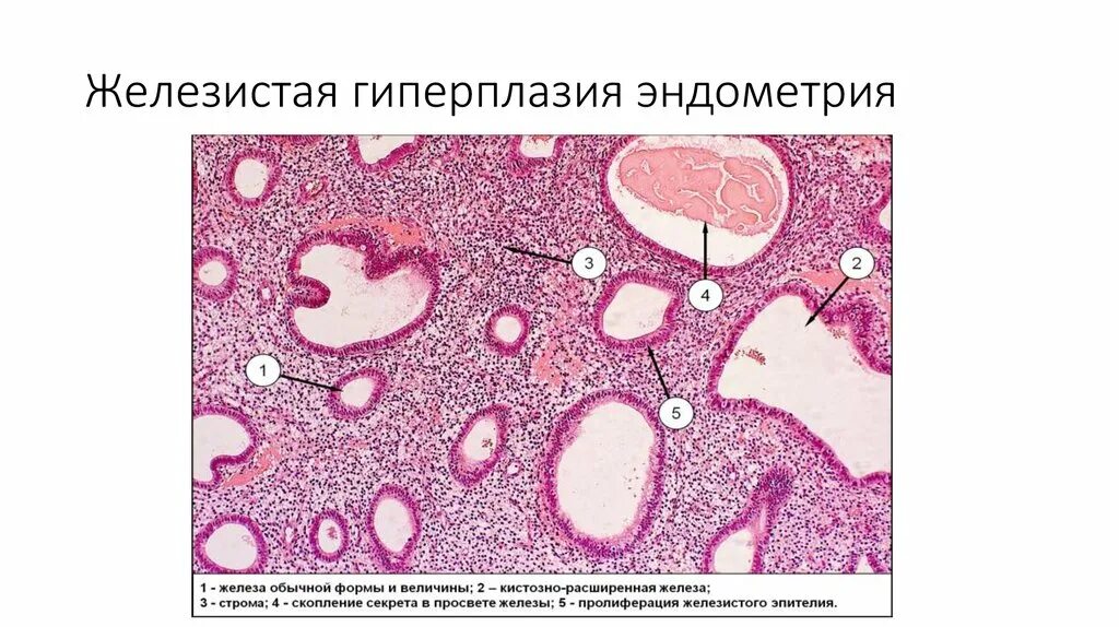 Гиперплазия эндометрия микропрепарат. Простая гиперплазия эндометрия микропрепарат. Железисто-кистозная гиперплазия эндометрия микропрепарат. Железистая гиперплазия слизистой оболочки матки. Г эндометрия