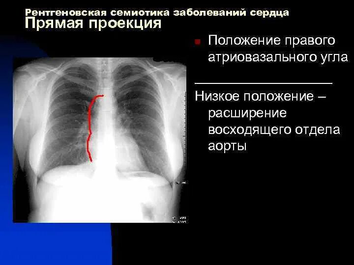 Дилатация правых отделов. Патология сердца на рентгенограмме. Расширение правых отделов сердца рентген. Патологии сердца на рентгене.