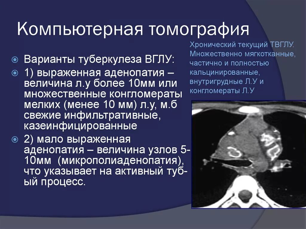 Кальцинаты в лимфоузлах. Туберкулез компьютерная томография. Туберкулез внутригрудных лимфатических узлов кт.