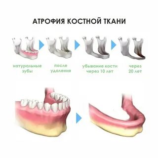 Через сколько после удаления зуба можно протезировать