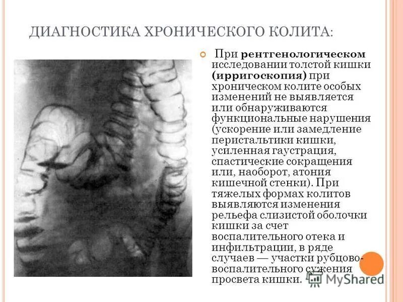 Диагноз хронического колита