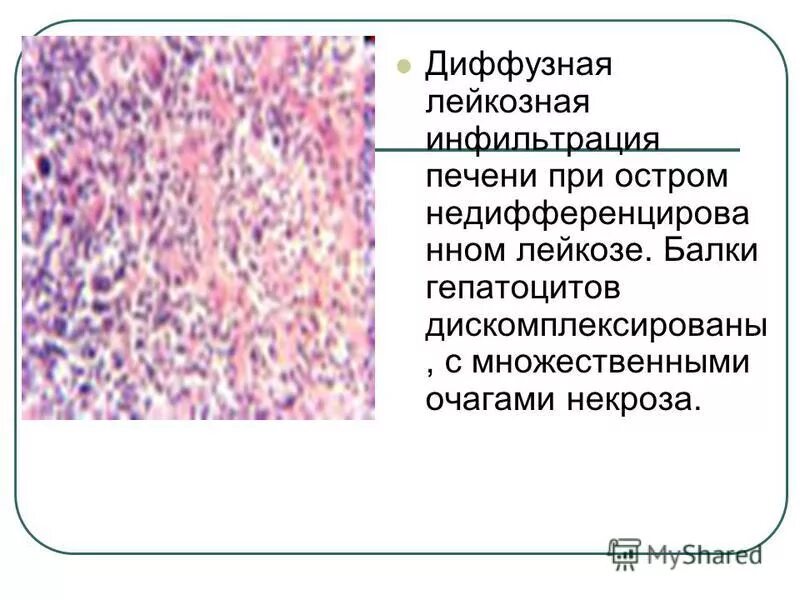 Диффузная лейкозная инфильтрация при хроническом миелолейкозе.. Печень при хроническом миелолейкозе микропрепарат. Лейкемический инфильтрат печени. Лейкозная инфильтрация печени.