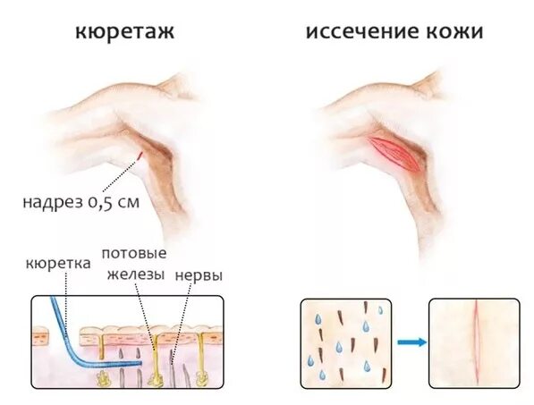 Операция пота
