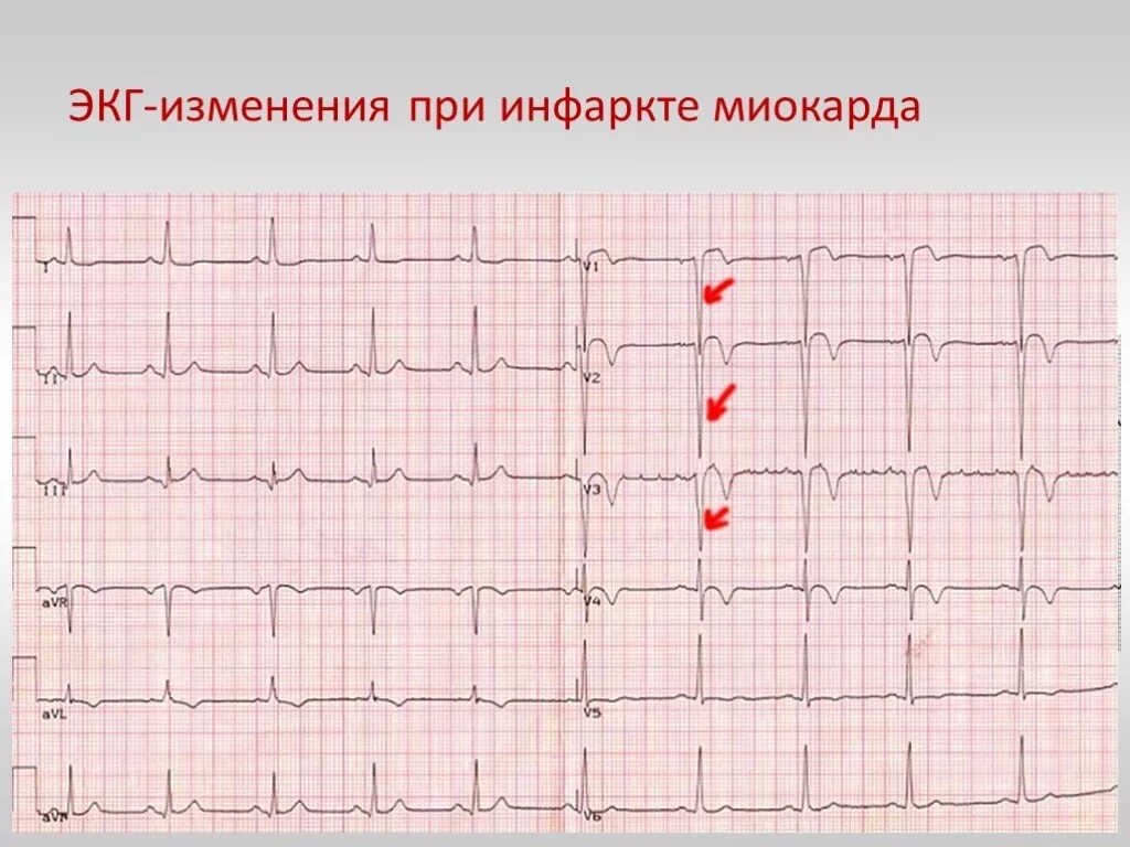 Экг сердца москва. Инфаркт миокарда на ЭКГ расшифровка. 5 Признаков ЭКГ при инфаркте миокарда. ЭКГ снимки инфаркта миокарда. ЭКГ пленки при инфаркте миокарда.