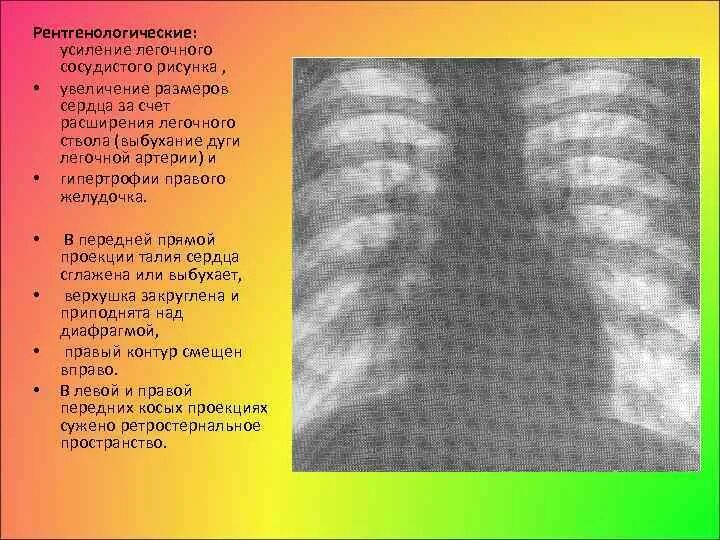 Усиление сосудистого рисунка. Легочный рисунок. Усиление сосудистого рисунка легких. Усиленный легочный рисунок.