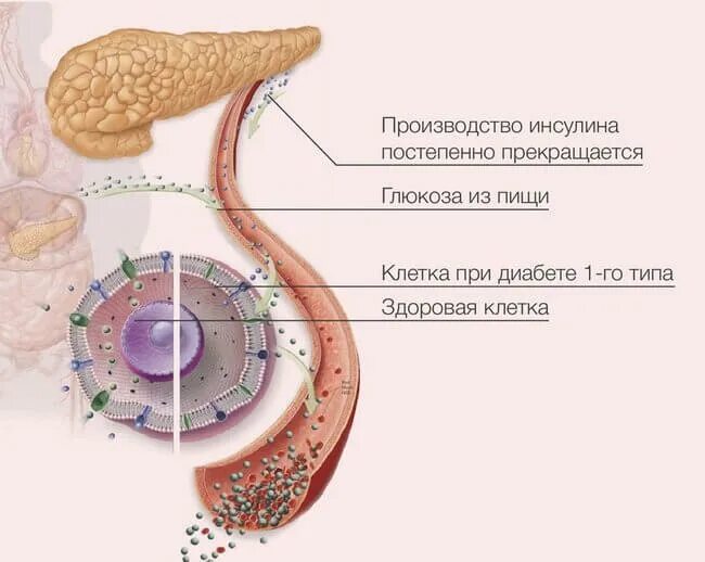 Идиопатический сахарный диабет. Идиопатический сахарный диабет 1 типа. Аутоиммунный и идиопатический сахарный диабет 1 типа. Идиопатический СД это. Клетка при сахарном диабете 2 типа.