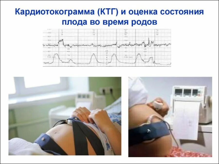 Исследование сердцебиения плода. Оценка состояния плода методом КТГ. Алгоритм оценка состояния плода методам КТГ. Кардиотокография плода методика проведения. КТГ В 3 триместре беременности.