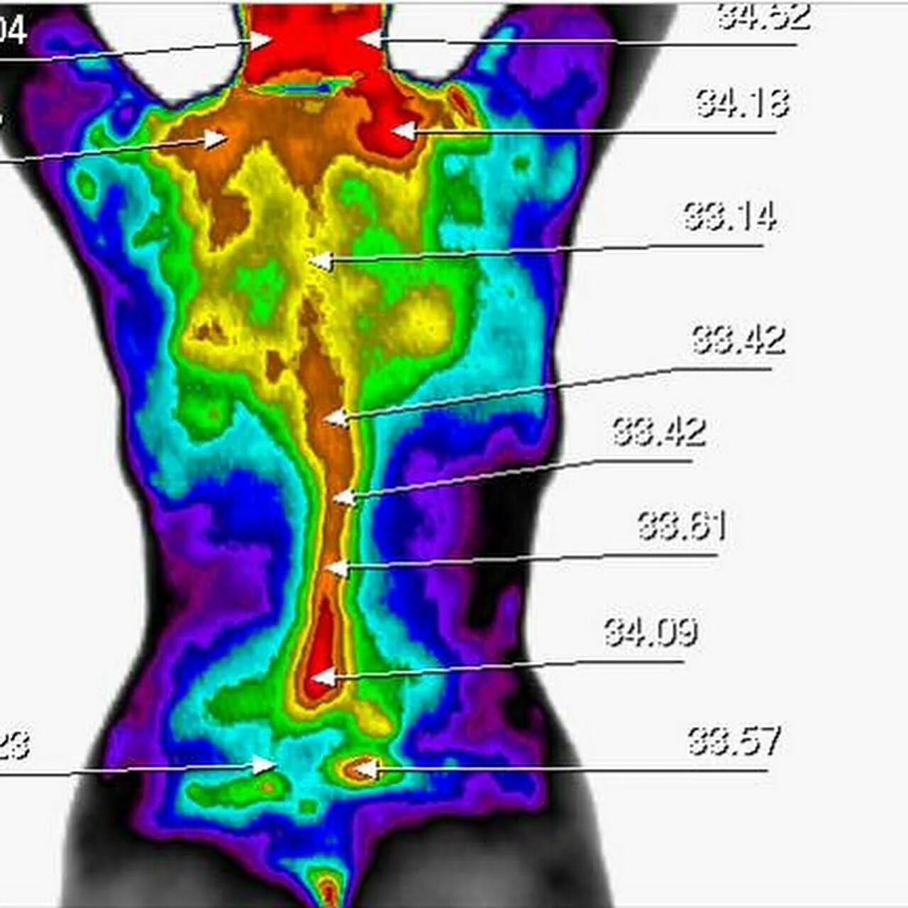 Какая температура в кишечнике человека. Тепловизор в медицине. Компьютерная термография в медицине. Термограмма здорового человека. Карта температуры тела человека.