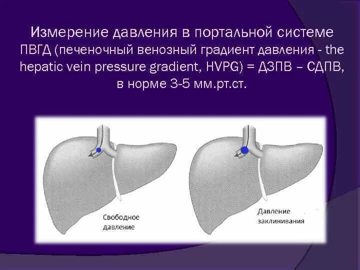 Печень расширены вены. Печеночный венозный градиент давления. Измерение давления в воротной Вене. Измерение давления в портальной Вене. Градиент венозного давления в печени.