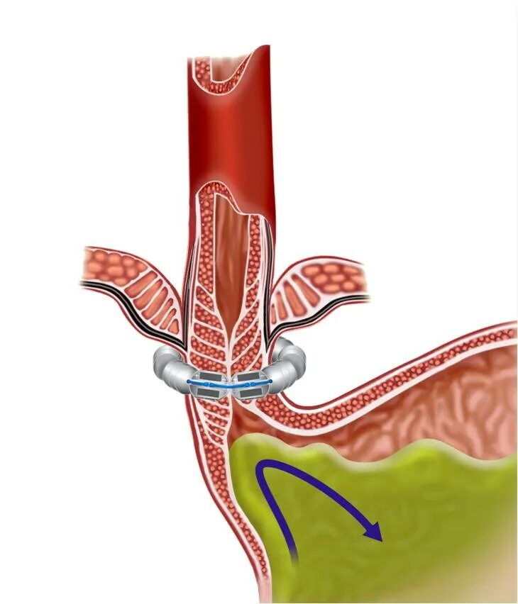 Операция рефлюксная болезнь Linx. Почему сфинктер