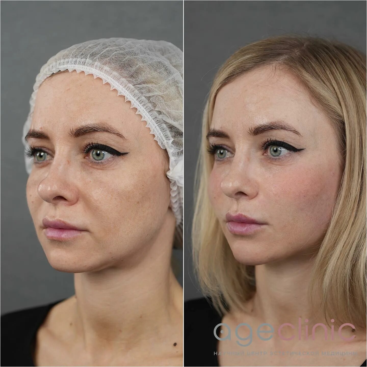Методика Full Face - омоложение лица цены Клиника косметологии ЛИКС