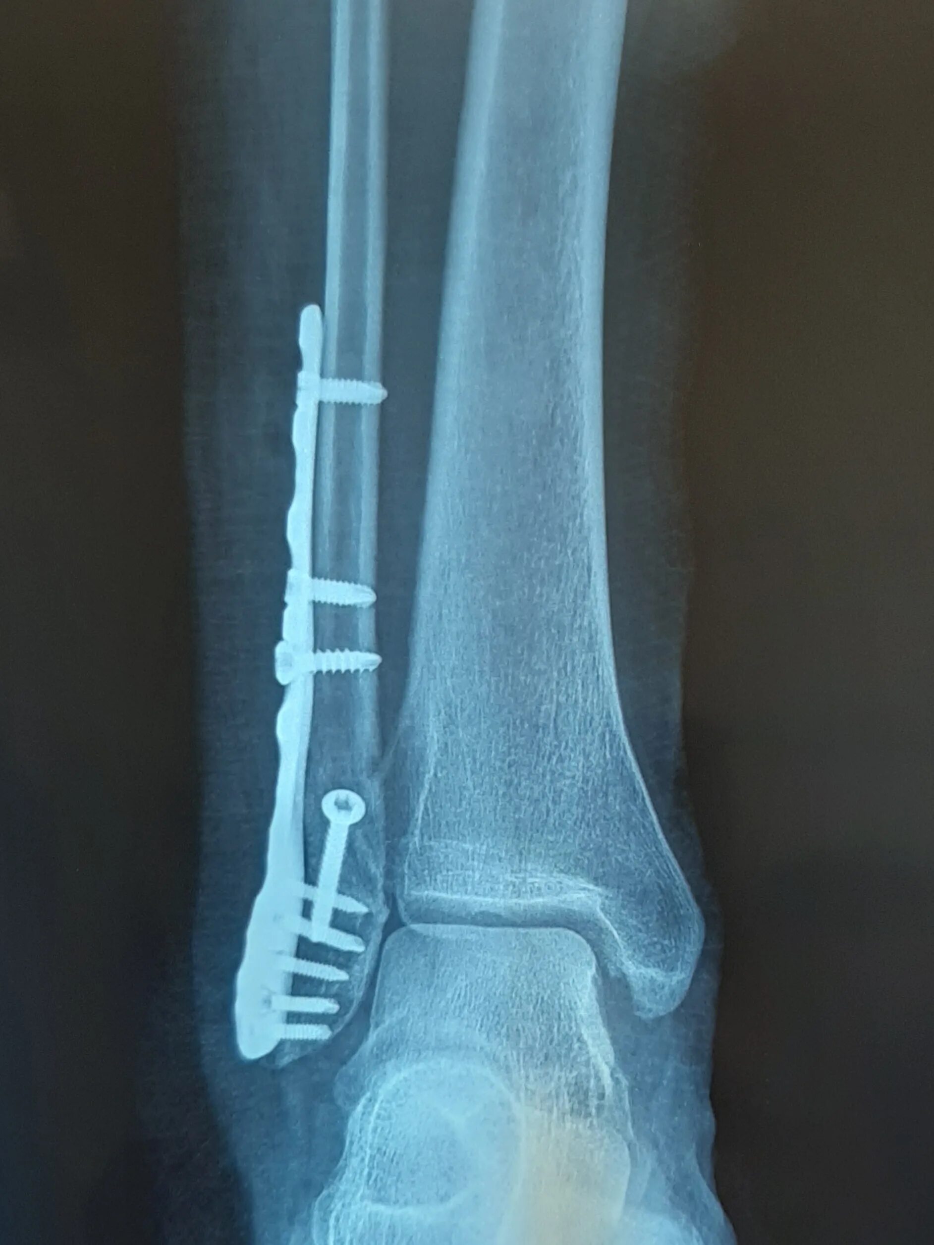 Сколько времени заживает нога. Перелом лодыжки с остеосинтезом. Апикальный перелом наружной лодыжки рентген. Апикальный перелом лодыжки. Внутрикостный остеосинтез лодыжки.