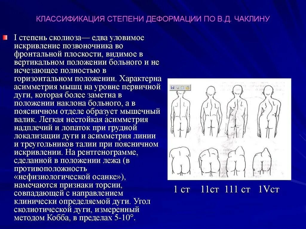 Сколиоз 8 степени. Степени сколиоза по в. д. чаклину. 1 степень сколиоза по чаклину рентген. сколиоз позвоночника 1 степени по чаклину. классификация кобба сколиоз.